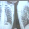 肺のレントゲン